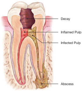 Root Canal Therapy Toronto Bloof Dufferin